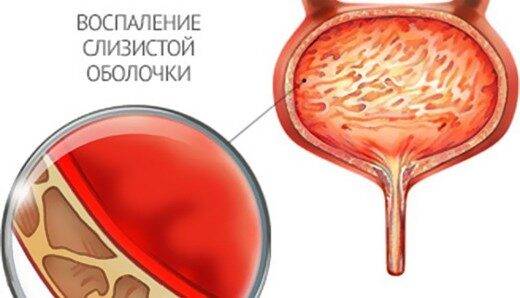 Простуда мочевого пузыря у мужчин симптомы