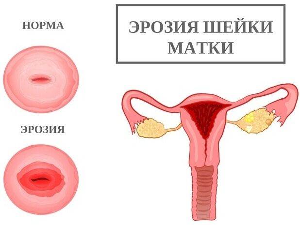 Воспаления по-женски придатков, почек, яичников, мочевого пузыря, лимфоузлов в паху, симптомы и лечение