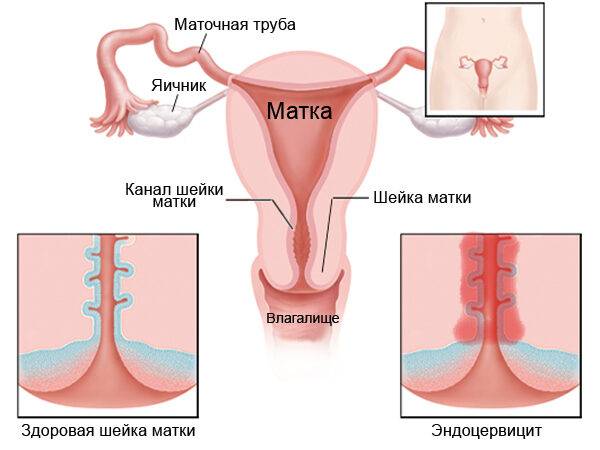 Воспаления по-женски придатков, почек, яичников, мочевого пузыря, лимфоузлов в паху, симптомы и лечение