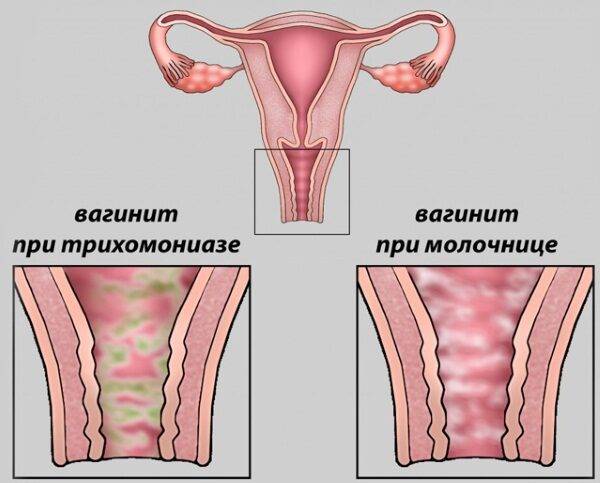 Воспаления по-женски придатков, почек, яичников, мочевого пузыря, лимфоузлов в паху, симптомы и лечение