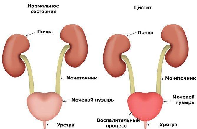 Воспаление уретры у женщин. Симптомы и лечение, народные средства от уретрита