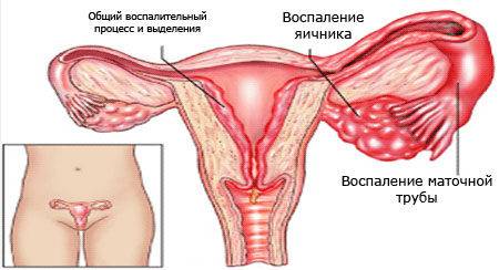 Свечи при воспалении яичников у женщин, обезболивающее, лечение. Отзывы, названия, цена препаратов