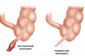 рисунок воспаления аппендицита