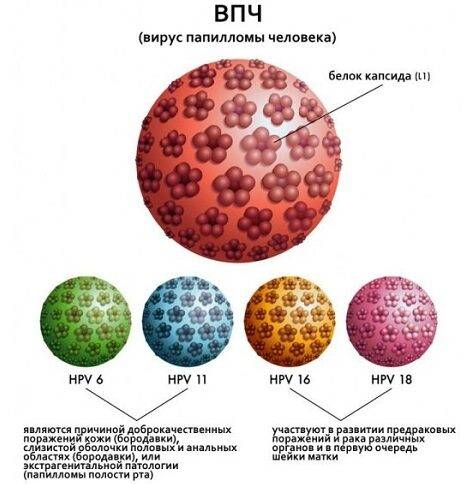 Что такое папиллома шейки матки, причины, симптомы, лечение