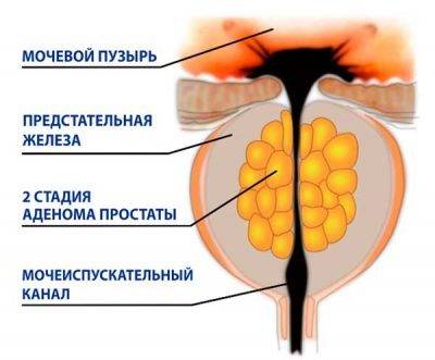 vtoraya_stadiya_adenomy_1_01145726-400x331-1